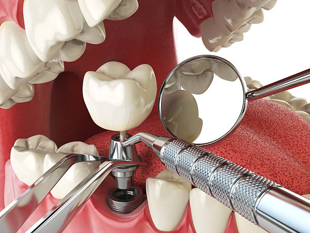 Best Broken or Cracked Tooth Emergency Dentist in Oxford, PA